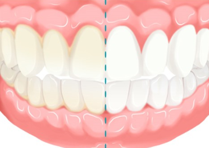 이빨 하얘지는법
